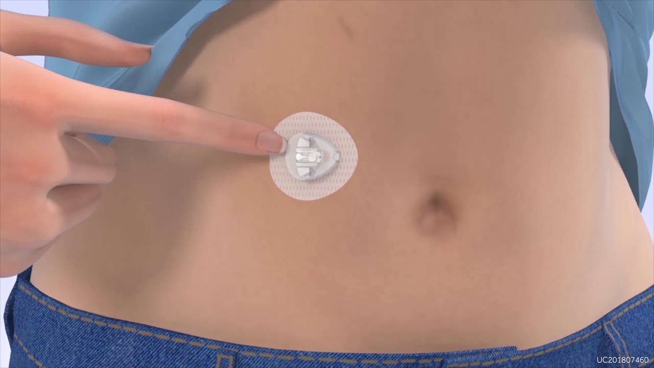 MiniMed Mio Advance Adalah Perangkat Infus Dengan Jarum Tidak Terlihat