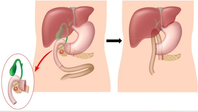 whipple surgery